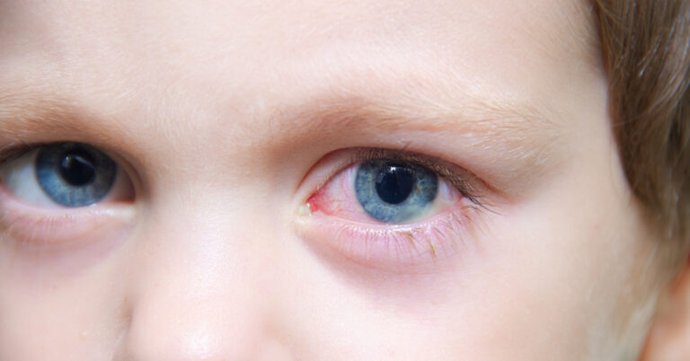 Child with pink eye