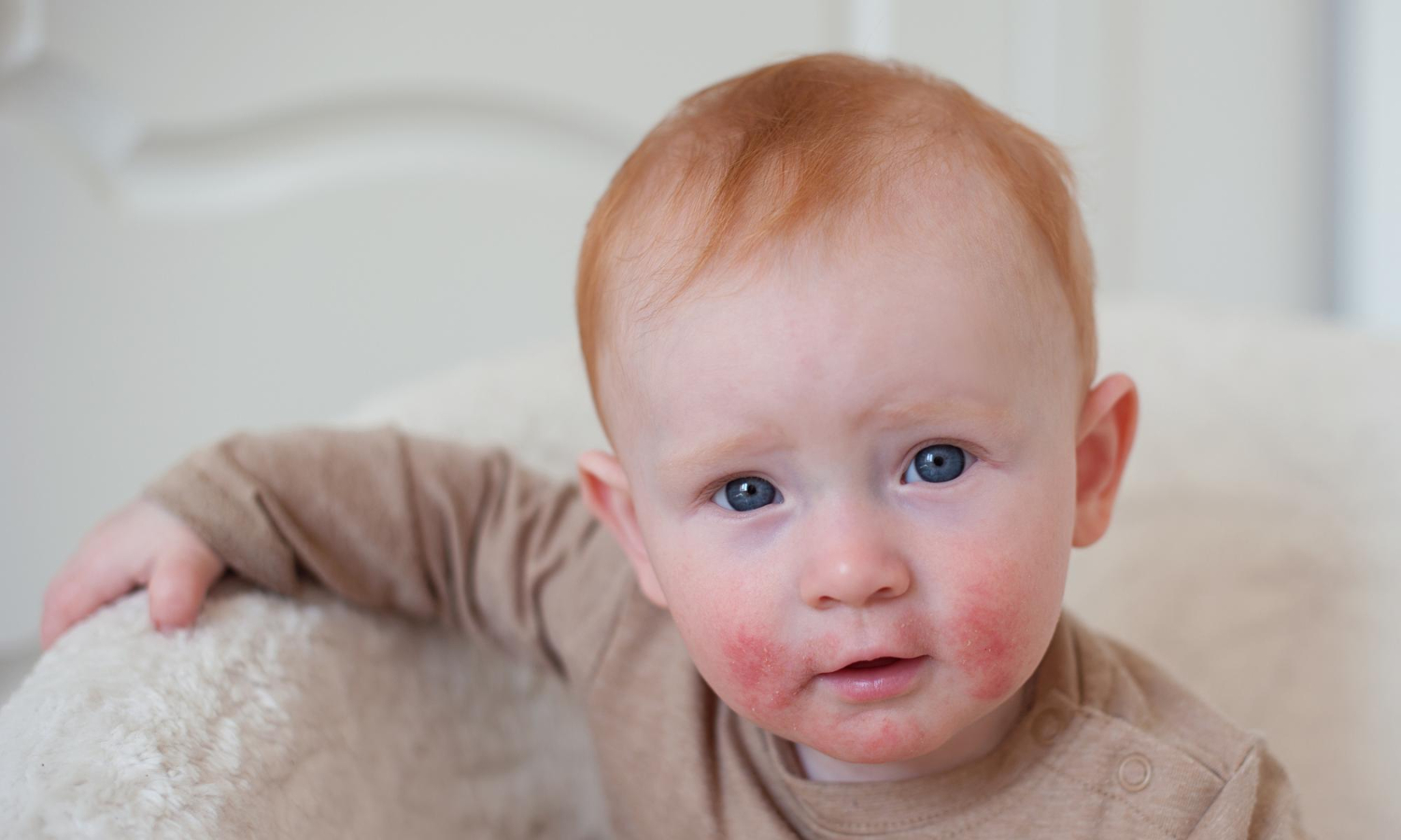 Infant with fair skin and light reddish hair showing red, dry patches on the cheeks, a common sign of childhood eczema.