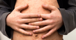 Close-up of a young person’s abdomen and hands showing a widespread red, blotchy rash consistent with measles symptoms.