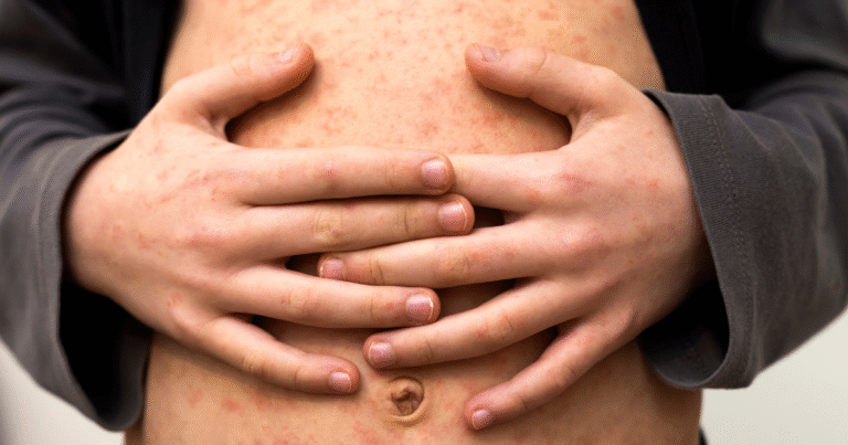 Close-up of a young person’s abdomen and hands showing a widespread red, blotchy rash consistent with measles symptoms.